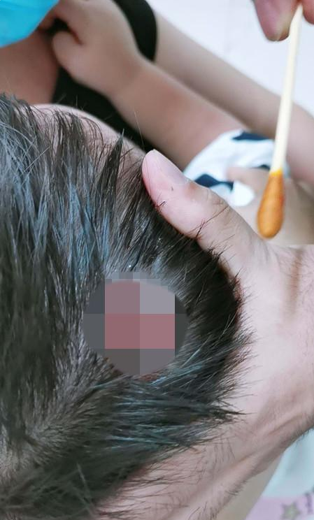 郑州市上街区建业联盟新城墙体脱落 两岁孩童头顶被砸出棱形伤口